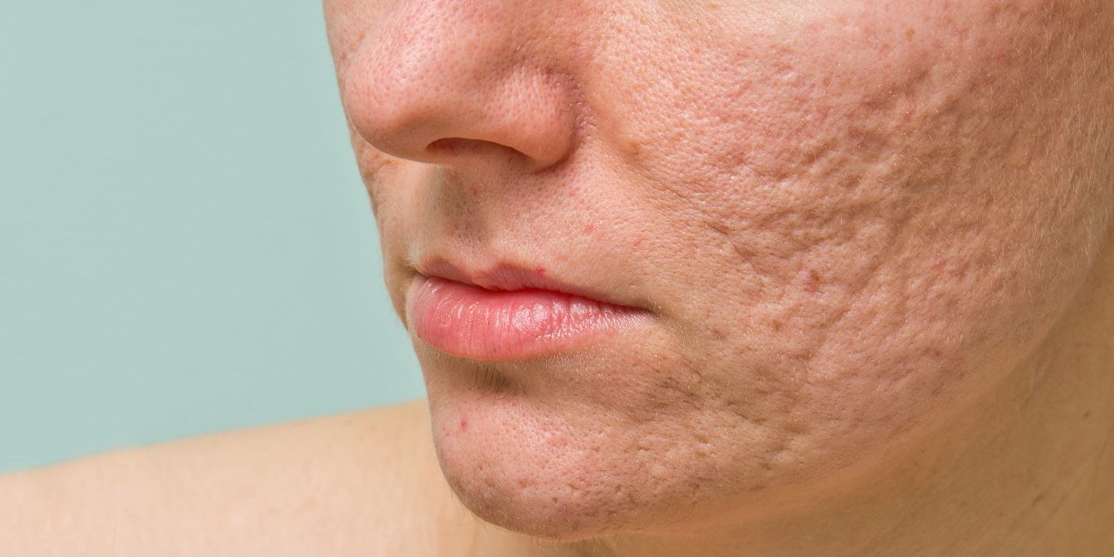 Acne scars revision